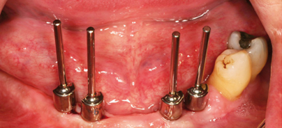 Implantatprothetische Rehabilitation 