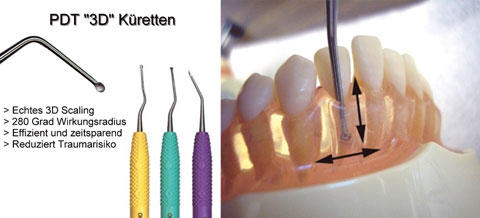 PDT "3D" Küretten