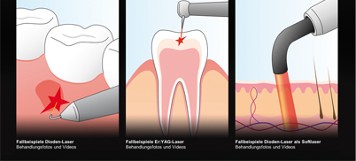 Dentallaser-App "elexxion"