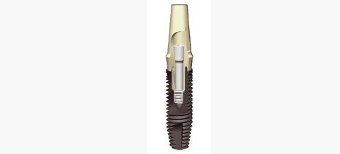 PerioType-X-Pert