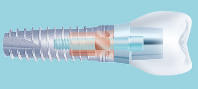 Alphatech Implantatsystem