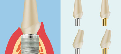 SKY Zirkonabutment 