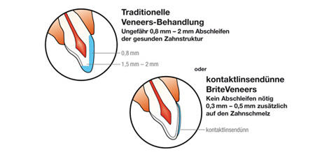 BriteVeneers One-Step ceramic
