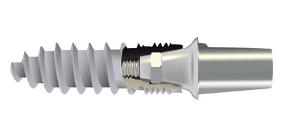 (R)Evolutions®-Implantat 