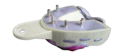 Miratray Implant