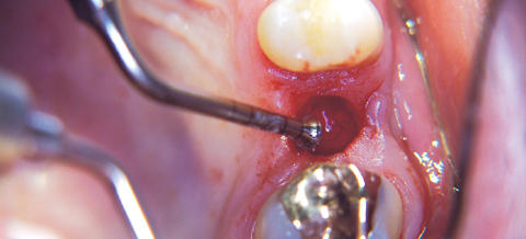 Piezotome und ImplantCenter