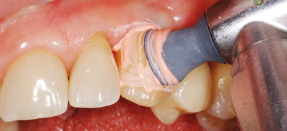 Implantatkronen: Funktion und Ästhetik lange erhalten 