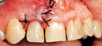Optimierter Heilungsprozess nach ­dento-alveolären chirurgischen Eingriffen