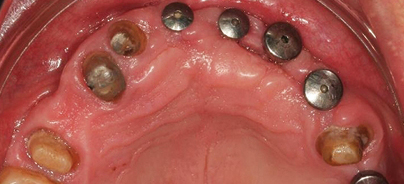 Subperiostale Augmentation zum minimal­invasiven Aufbau des Alveolarkamms