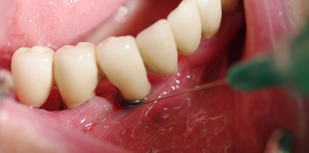 Langzeitbehandlung periimplantärer ­Läsionen in der Alterszahnheilkunde