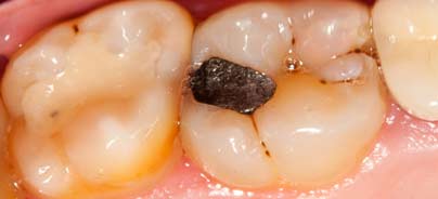 Kariesdiagnose mit System