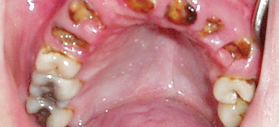 Die postendodontische Versorgung stark zerstörter Zähne 