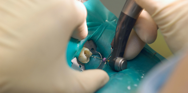 Analogie in der Endodontie