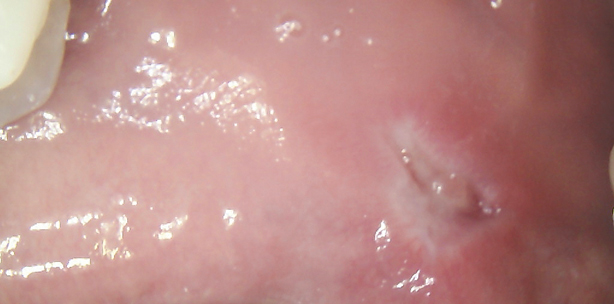 Laserbehandlung eines Fibroms 