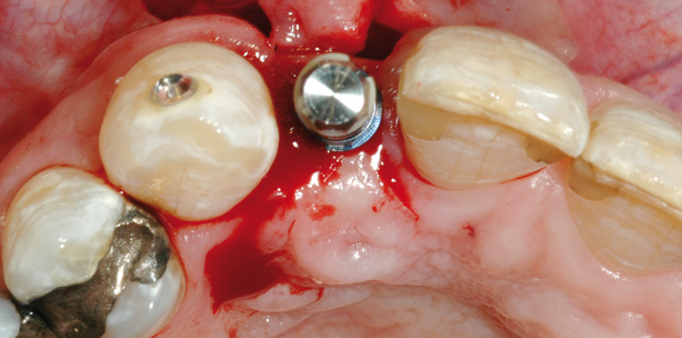 Mikroschrauben in der augmentativen Chirurgie