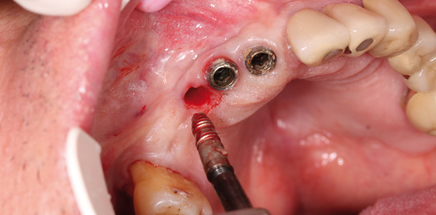 Implantatentfernung: Suche nach der schonendsten Methode