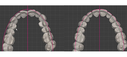 Das „Customized“ Alignersystem