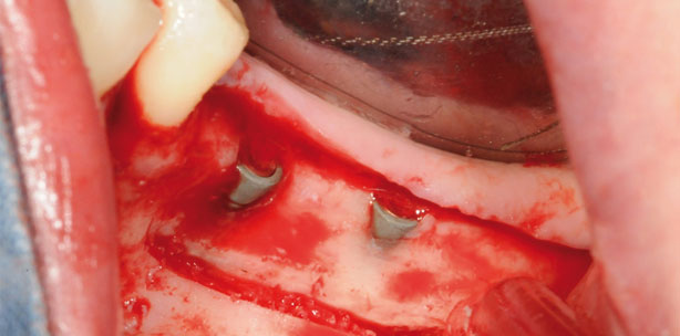 Knochenaugmentation im Unterkieferseitenzahnbereich 