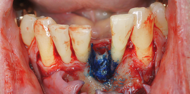 Minimalinvasive Rekonstruktion eines Unterkieferfrontzahnes 