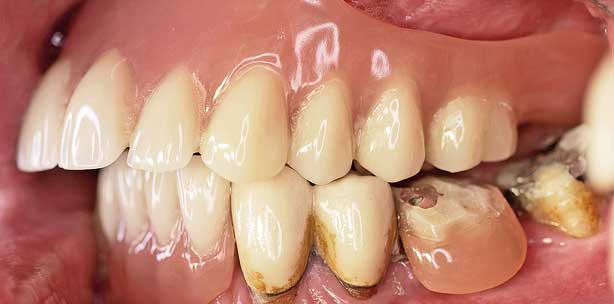 Implantatprothetische Versorgung des atrophierten Oberkiefers