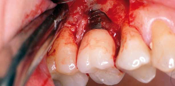 Periimplantäre Läsionen – Entstehung und Therapieoptionen