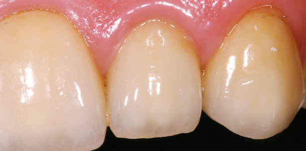 Postendodontische Versorgung unter ­ästhetischen und funktionellen Aspekten