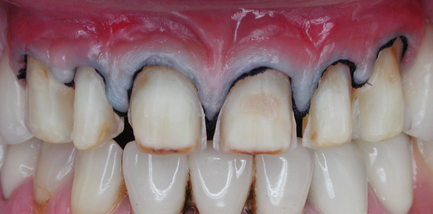 Rehabilitation einer OK-Front mit koronalem Verschiebelappen und Veneers