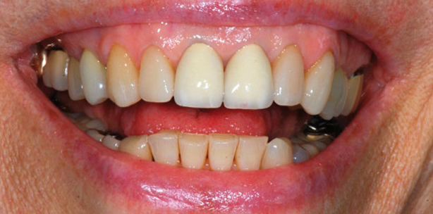 Ästhetische Ergebnisse mit transgingival einheilenden Implantaten