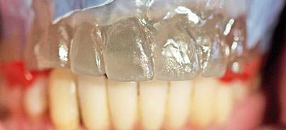 Abformung und Registrierung für ­implantatgetragenen Zahnersatz