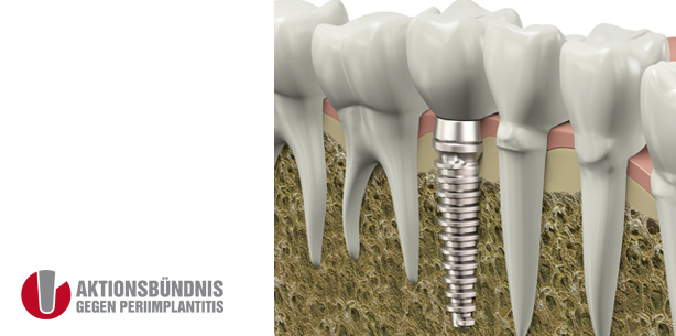 Aktionsbündnis gegen Periimplantitis