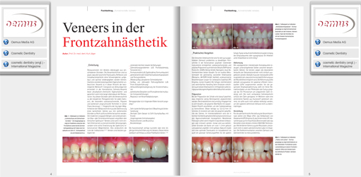 Minimalinvasiv ist Trumpf: Neues eBook "Veneers" 