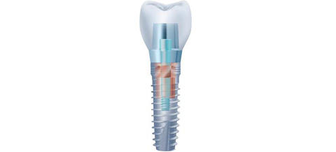 alphatech®-Implantate