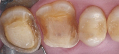 Teilkronen aus Keramik – ein Therapiekonzept im Fluss | ZWP online