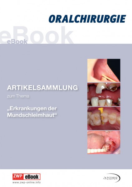 eBook "Erkrankung der Mundschleimhaut"