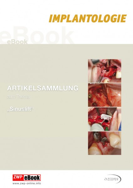 eBook Sinuslift