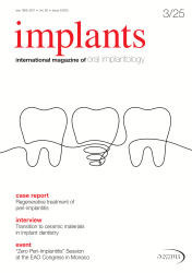 implants 03/25