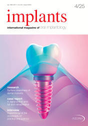 implants 04/25