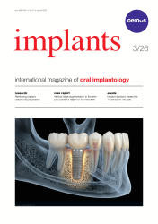 implants 03/26