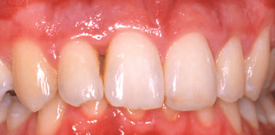 Systematik einer erfolgreichen Parodontitistherapie