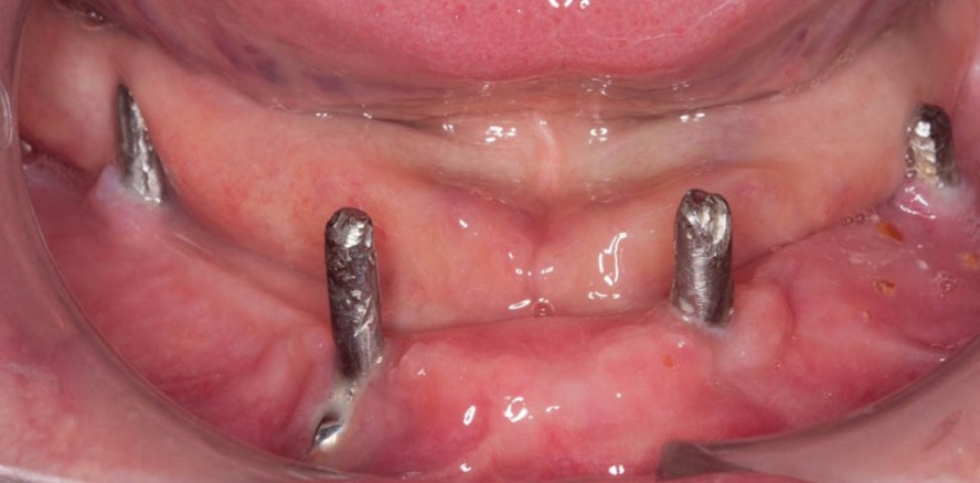 Der geriatrische Patient und Implantate – Fluch oder Segen?