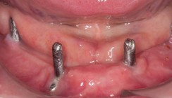 Der geriatrische Patient und Implantate – Fluch oder Segen?