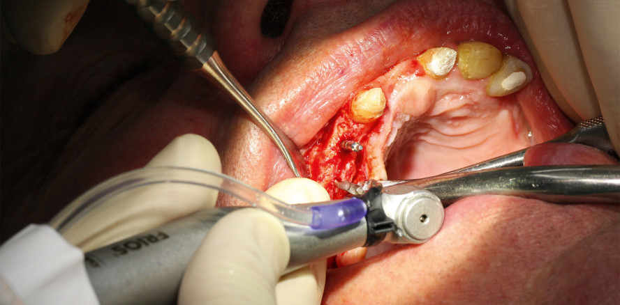 Zwischen Ästhetik und Funktion: Festsitzende Rehabilitation im OK