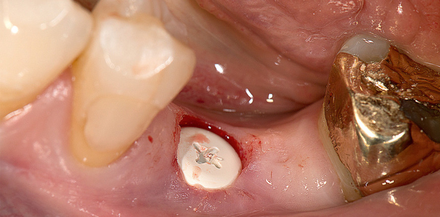Metallfreie Implantatversorgung im Unterkiefer