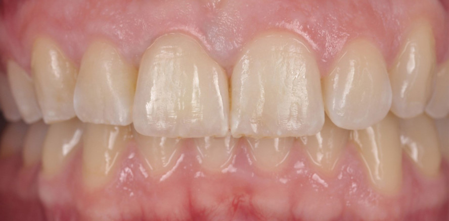 Experten-Seminar: Implantat­prothetik mit ZTM Andreas Kunz