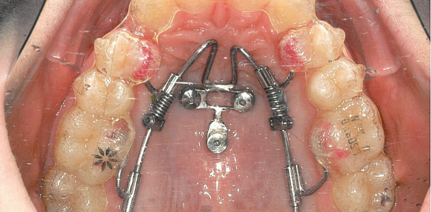 Lückenmanagement bei 2er-Aplasie mit Slider, Aligner & Co.