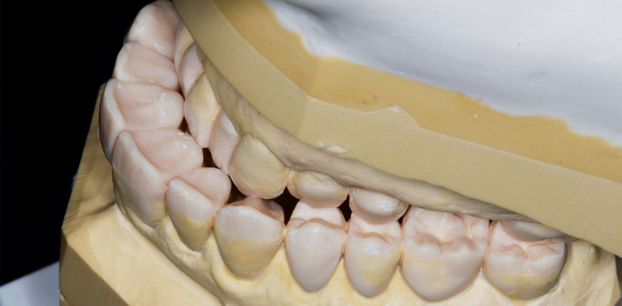 4-Quadranten-Rehabilitation im abrasionsgeschädigten Gebiss