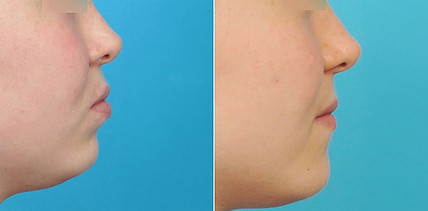 Aesthetics Follows Function – Extraktionstherapie auch aus ästhetischer Sicht?