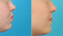 Aesthetics Follows Function – Extraktionstherapie auch aus ästhetischer Sicht?