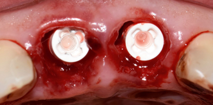 Wiederherstellung der Ästhetik im Frontzahnbereich