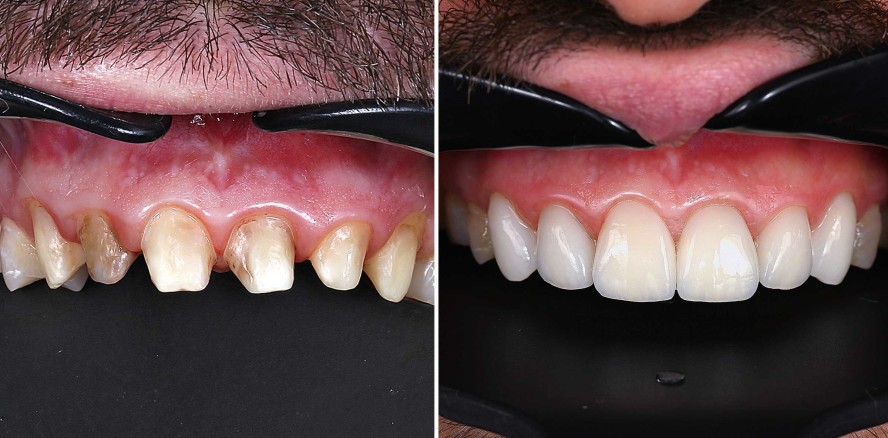 Ästhetische Rehabilitation der Oberkieferfront